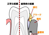 直接的原因＝プラーク