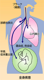 歯周病の危険性