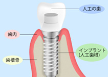 快適な噛み心地を～インプラント～