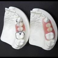 ノンクラスプデンチャー