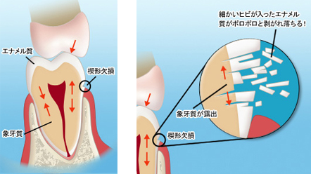 マウスピースで口腔内を守ろう